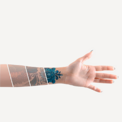 Remoção de tatuagem