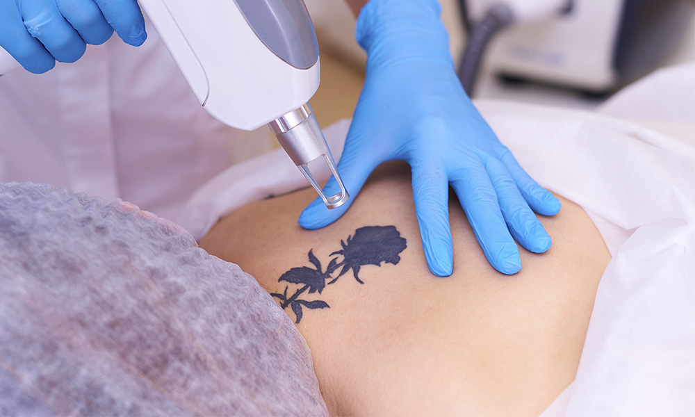 remoção de tatuagem Clínica Landecker