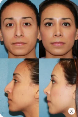 Rinoplastia: antes e depois