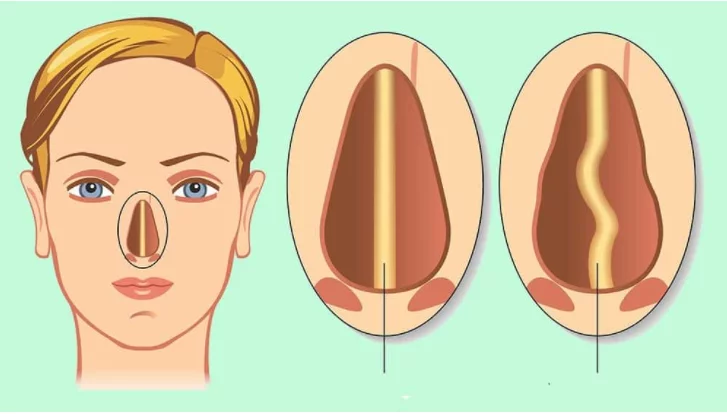 rinoplastia desvio de septo