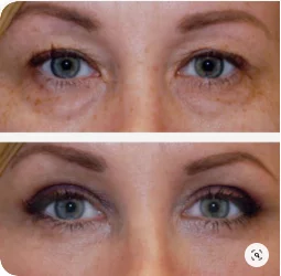 blefaroplastia transconjuntival