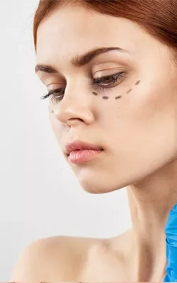Blefaroplastia: recupere a beleza do seu olhar