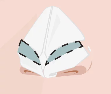 rinoplastia estruturada