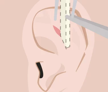 rinoplastia estruturada