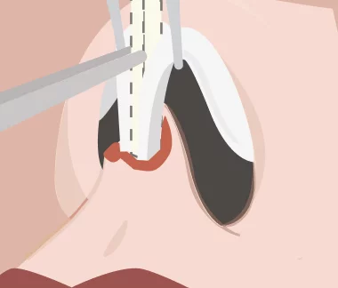 rinoplastia estruturada