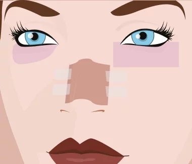 rinoplastia estruturada