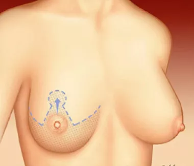 Cirurgia de Redução das Mamas