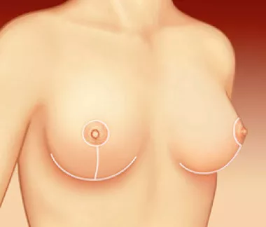 Cirurgia de Redução das Mamas