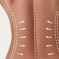 Lipoaspiração