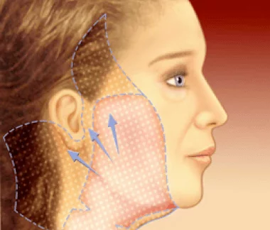 Rinoplastia Balanceada