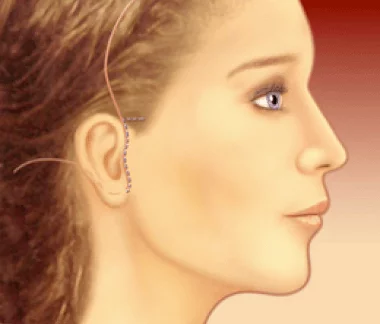 Rinoplastia Balanceada Preservadora