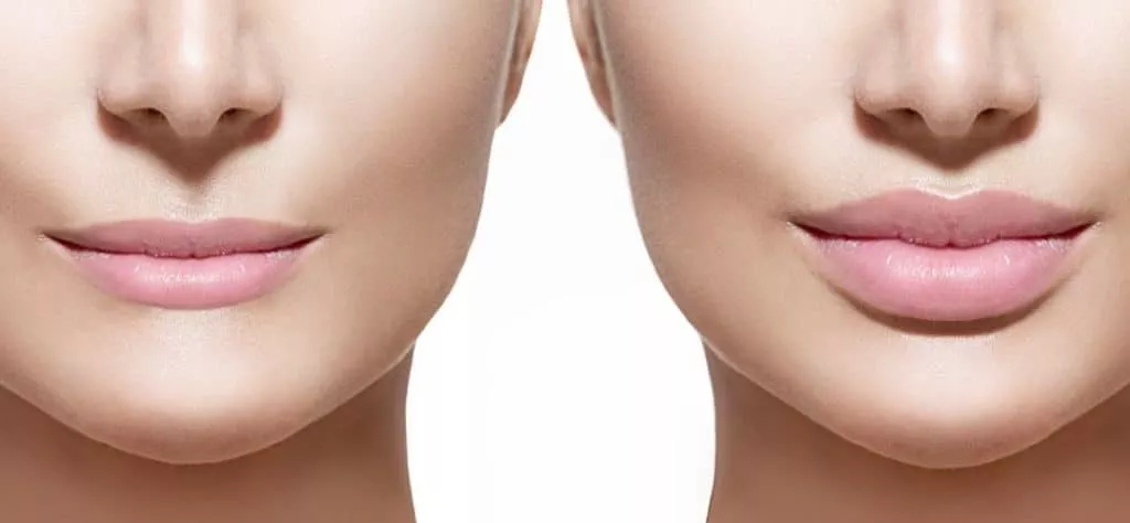preenchimento-labial-e-toxina-botulinica